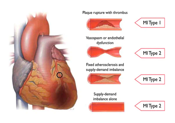 Detection of type 2 myocardial infarction from photoplethysmography using CNN-LSTM neural networks and manifold learning