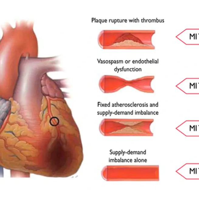 Detection of type 2 myocardial infarction from photoplethysmography using CNN-LSTM neural networks and manifold learning